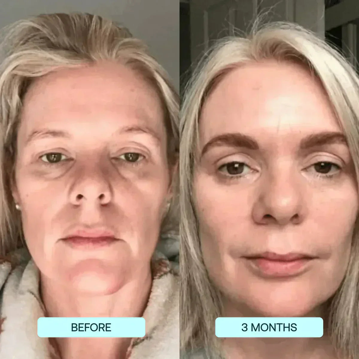 Pure Collagen Forehead Mask | 📢 SALE 60% OFF Today 🏷️