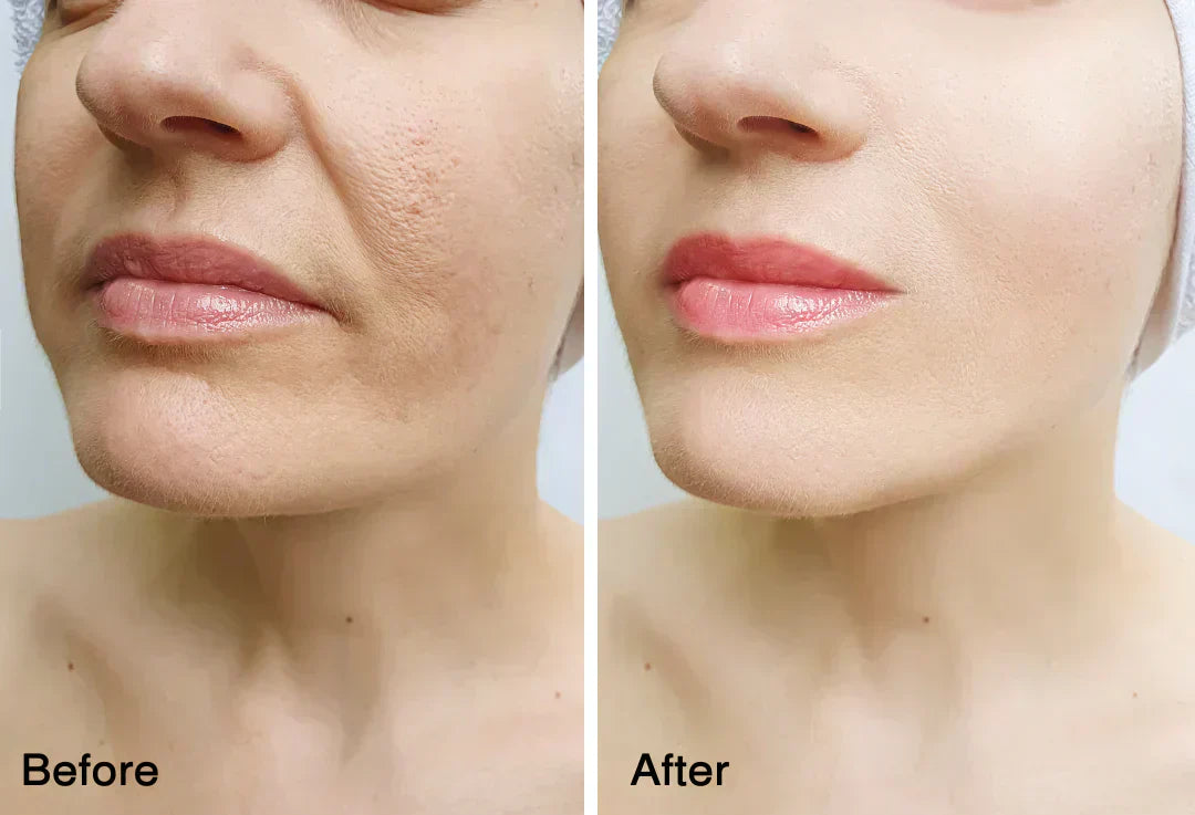 Pure Collagen Forehead Mask | 📢 SALE 60% OFF Today 🏷️